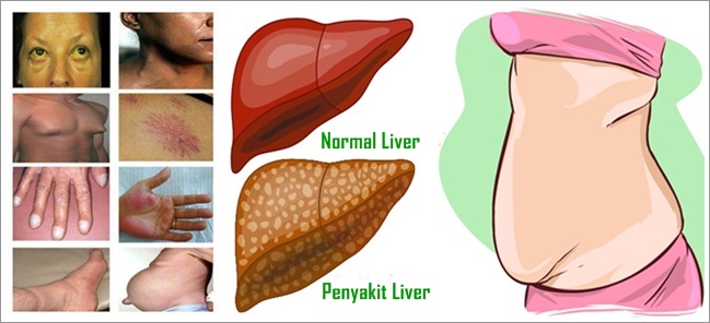 Cara Mengobati Penyakit Liver Secara Alami